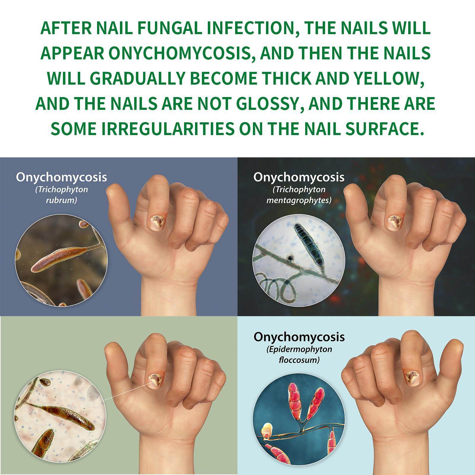 Jiasuying Ginger Nail Care Liquid, Repairs And Moisturizes Hand And Foot Nails, Makes Nails Shiny And Soft, And Improves Onychomycosis
