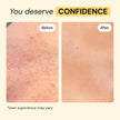 MyMagicHealer Universal Flare Care – Multi-Purpose Solution | Skin Flare-Ups - Hidradenitis Suppurativa, Folliculitis, Boils, Cysts | Anti-Chafing | Irritated Skin Relief w/Propolis & Egg Yolk 28 g 🍁 All In One Marketplace Canada