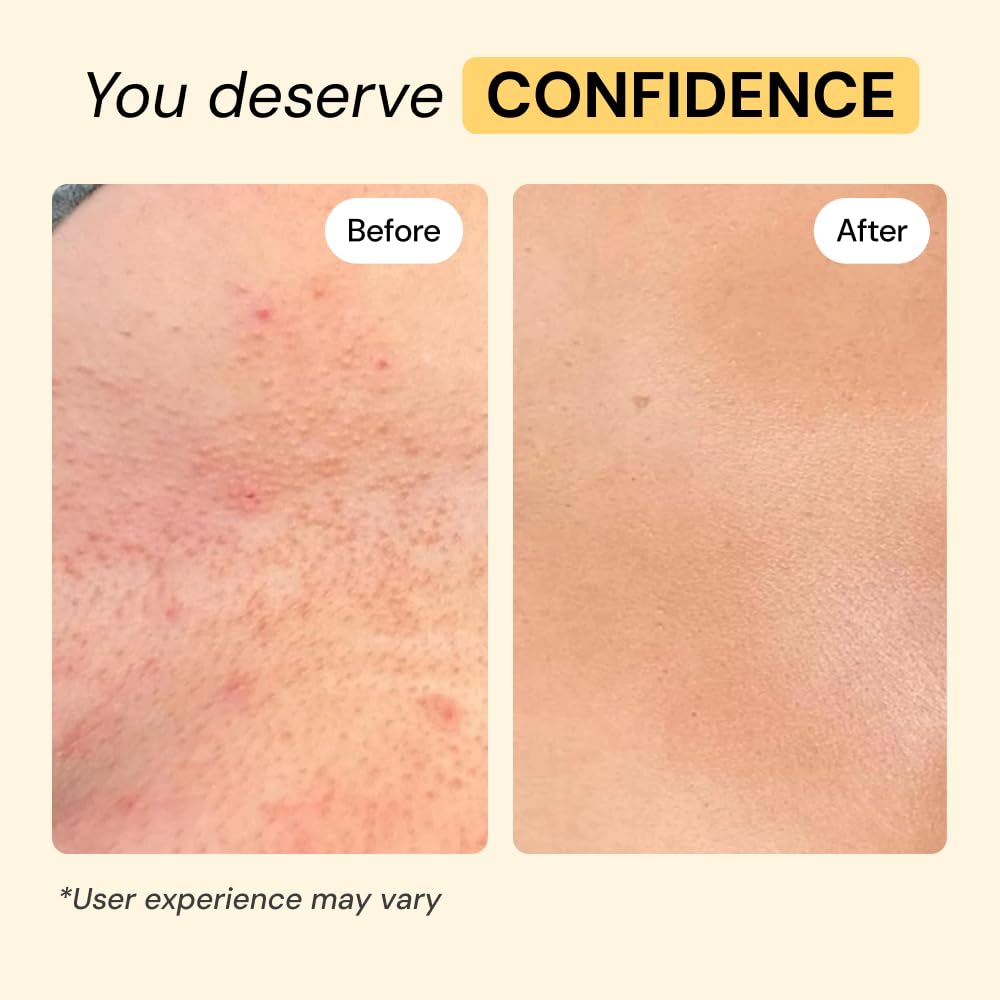 MyMagicHealer Universal Flare Care – Multi-Purpose Solution | Skin Flare-Ups - Hidradenitis Suppurativa, Folliculitis, Boils, Cysts | Anti-Chafing | Irritated Skin Relief w/Propolis & Egg Yolk 28 g 🍁 All In One Marketplace Canada