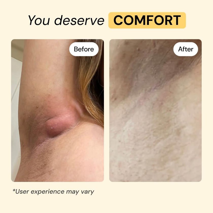 MyMagicHealer Universal Flare Care – Multi-Purpose Solution | Skin Flare-Ups - Hidradenitis Suppurativa, Folliculitis, Boils, Cysts | Anti-Chafing | Irritated Skin Relief w/Propolis & Egg Yolk 28 g 🍁 All In One Marketplace Canada