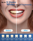 MySmile Teeth Whitening Gel Refills Pack 30+ Treatment Non-Sensitive Enamel Safe Tooth Whitener -10 Min Fast Whitening Teeth - Helps to Remove Stains from Coffee, Smoking, Wines（Excluding Tray Light） 🍁 All In One Marketplace Canada