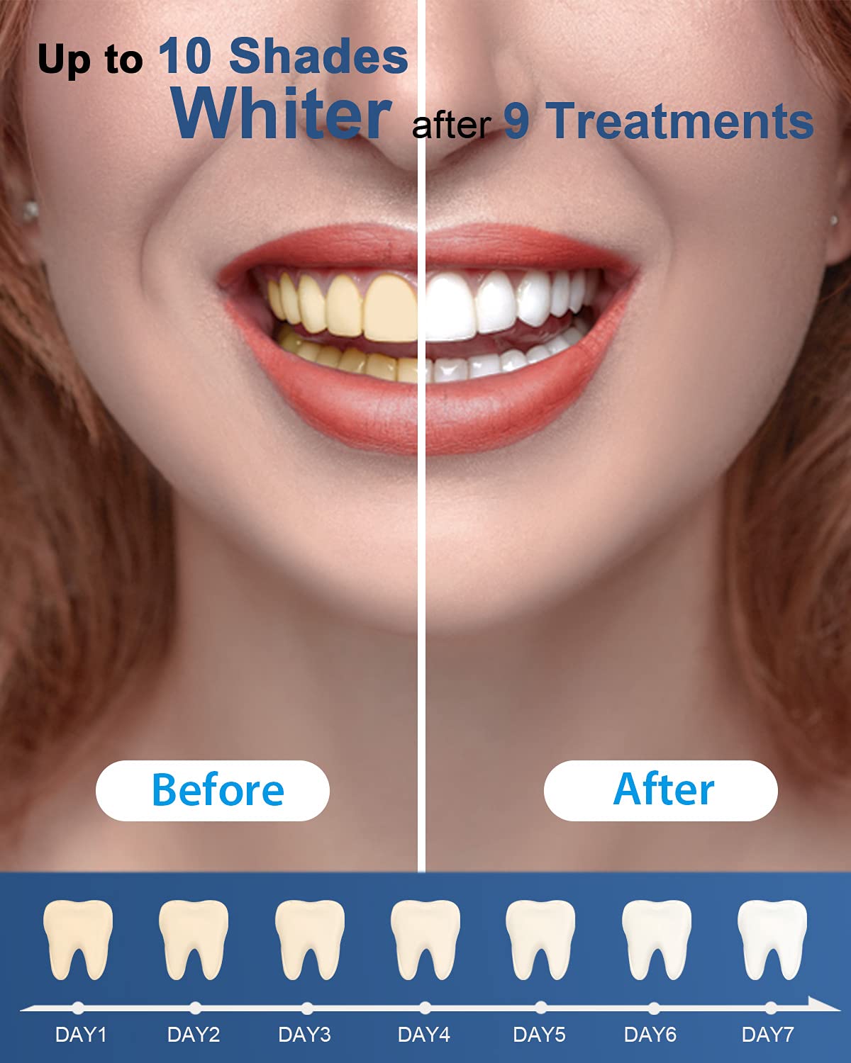 MySmile Teeth Whitening Gel Refills Pack 30+ Treatment Non-Sensitive Enamel Safe Tooth Whitener -10 Min Fast Whitening Teeth - Helps to Remove Stains from Coffee, Smoking, Wines（Excluding Tray Light） 🍁 All In One Marketplace Canada