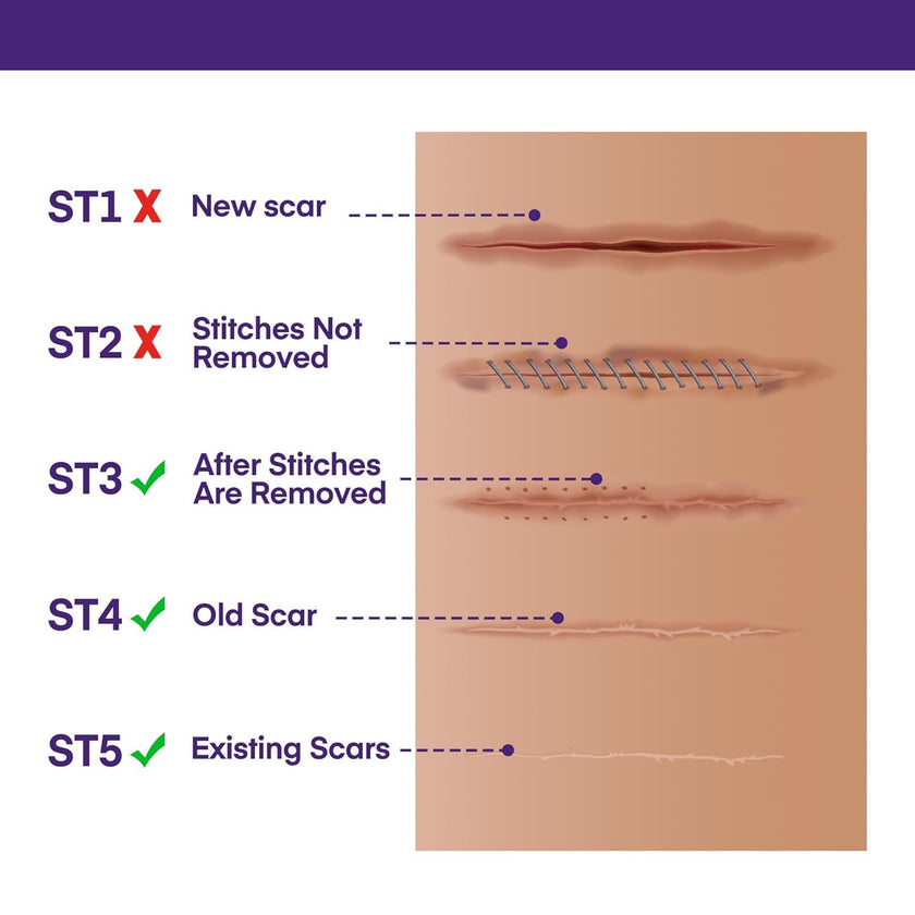 Silicone Scar Gel Scar Cream - SPF 30 Advanced Scar Gel for Old and New Scars 🍁 All In One Marketplace Canada