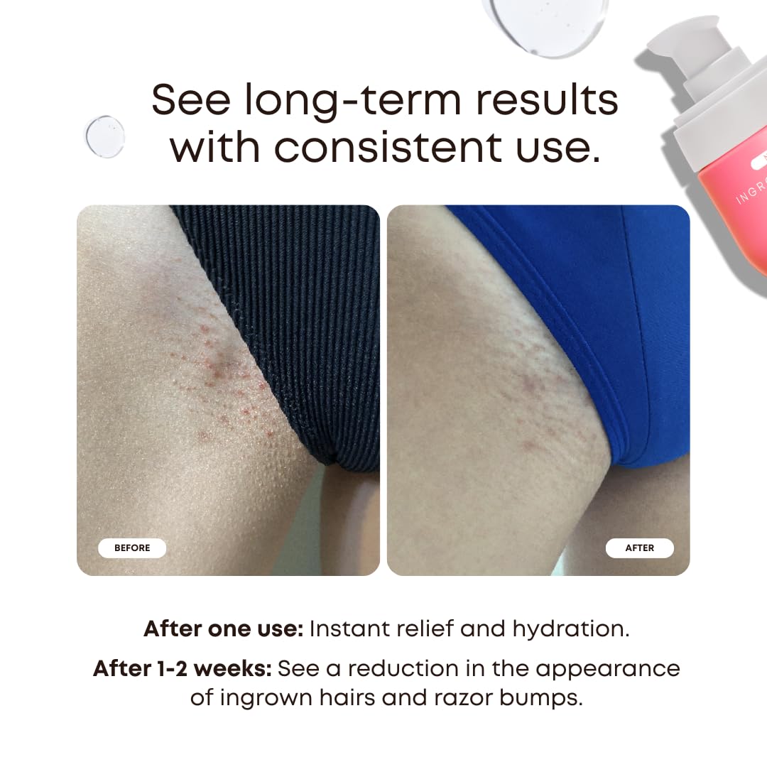 Bushbalm Ingrown Hair 2 Step Routine - Moisturize and Soothe - Ingrown Hair Oil (30 ml), Exfoliating Scrub (236 ml) - Watermelon Sugar - Valued at $49 🍁 All In One Marketplace Canada