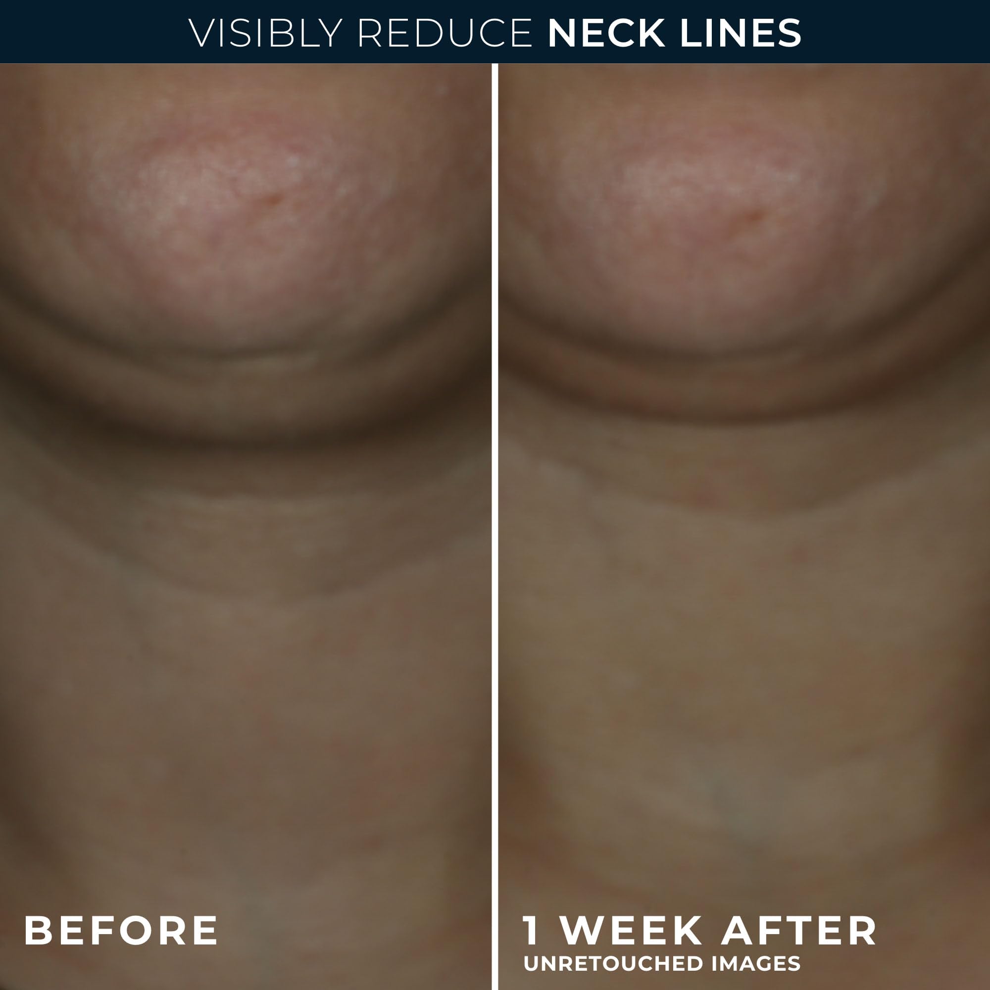 RoC Derm Correxion® Neck Cream with Hyaluronic Acid and Advanced Retinol to visibly Tighten & Lift Horizontal Neck Lines, Facial Moisturiser to Contour Face, Neck and Jawline, 50ML 🍁 All In One Marketplace Canada