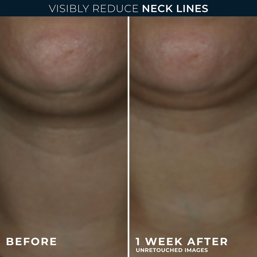 RoC Derm Correxion® Neck Cream with Hyaluronic Acid and Advanced Retinol to visibly Tighten & Lift Horizontal Neck Lines, Facial Moisturiser to Contour Face, Neck and Jawline, 50ML 🍁 All In One Marketplace Canada