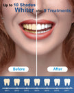 MySmile Teeth Whitening Kit with Whitening Light - 4Pcs Non-Sensitive Enamel Safe Teeth Whitening Gel,10 Min Fast-Result Home Tooth Whitening Dental Care Help Remove Teeth Stain 🍁 All In One Marketplace Canada