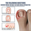 Relieving And Repairing Ingrown Nail Toe Nail Removing Meat Treatment Oil