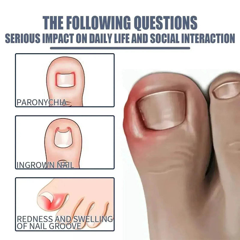 Relieving And Repairing Ingrown Nail Toe Nail Removing Meat Treatment Oil