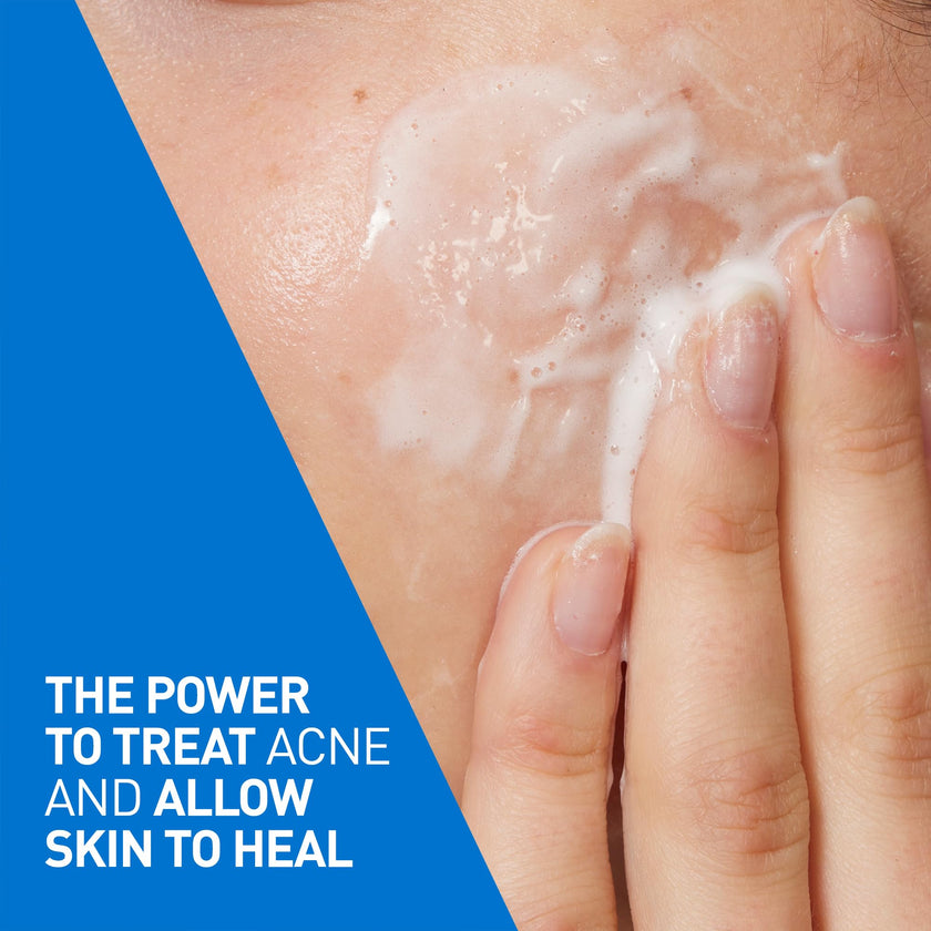 CeraVe 4% Benzoyl Peroxide Acne Treatment Foaming Cleanser Face & Body Wash, with Hyaluronic Acid and Niacinamide. Helps Clear Acne Pimples and prevent breakouts. Gentle Gel, Fragrance-Free, 150ML 🍁 All In One Marketplace Canada