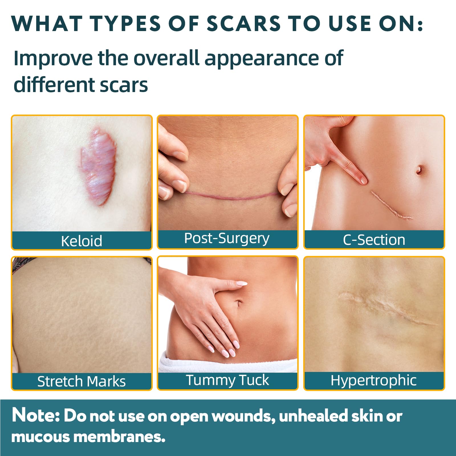 Silicone Scar Sheets, Silicone Scar Tape for Surgical Scars - 60