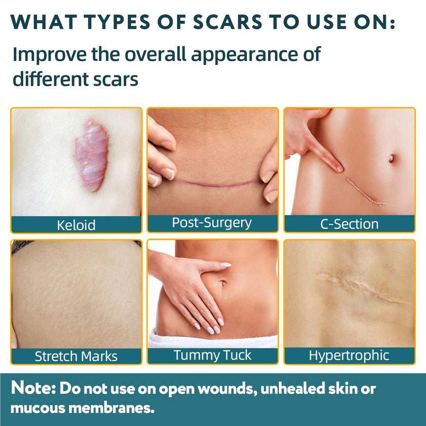 Silicone Scar Sheets, Silicone Scar Tape for Surgical Scars - 60