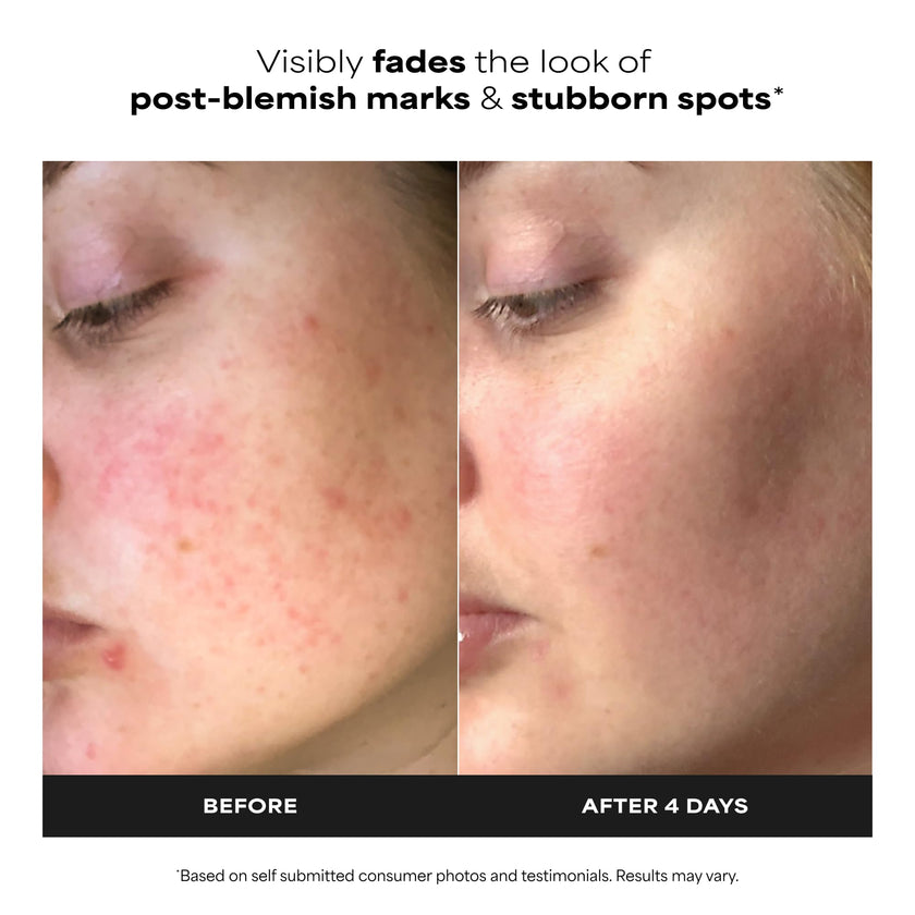 Paula's Choice BOOST 10% Azelaic Acid Booster Cream Gel, Licorice Extract & Salicylic Acid, Oil-Free Skin Serum, Fragrance-Free, 30 ml 🍁 All In One Marketplace Canada