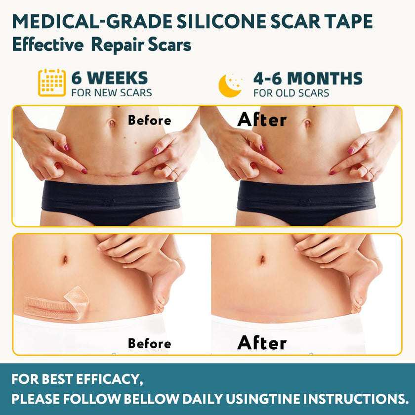 Silicone Scar Sheets, Silicone Scar Tape for Surgical Scars - 60