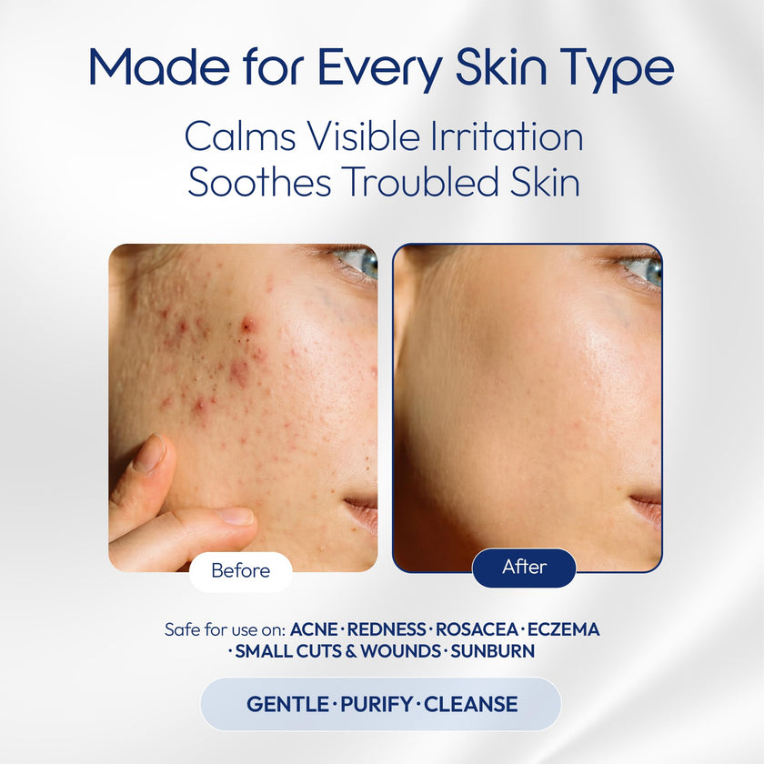 Hypochlorous Acid Spray – Acne Prone Skin – Dry Face – Eczema Prone Skin - Tattoo Aftercare – Piercing Aftercare – Saline Toner – Facial Cleanser – Eye Lash Cleanser - All Natural Face and Skin Spray – Safe for All Skin Types – Hypoallergenic – Cruelty Fr