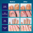 Tobcharm Nail Fungus Treatment for Toenails, Toe Nail Fungus Treatment, Nail Fungus Treatment, Toenail Fungus Treatment, Toe Fungus Treatment Extra Strength, Fungus Nail Killer, Nail Antifungal, Fungal Nail Treatment for Fingernails (30ml)