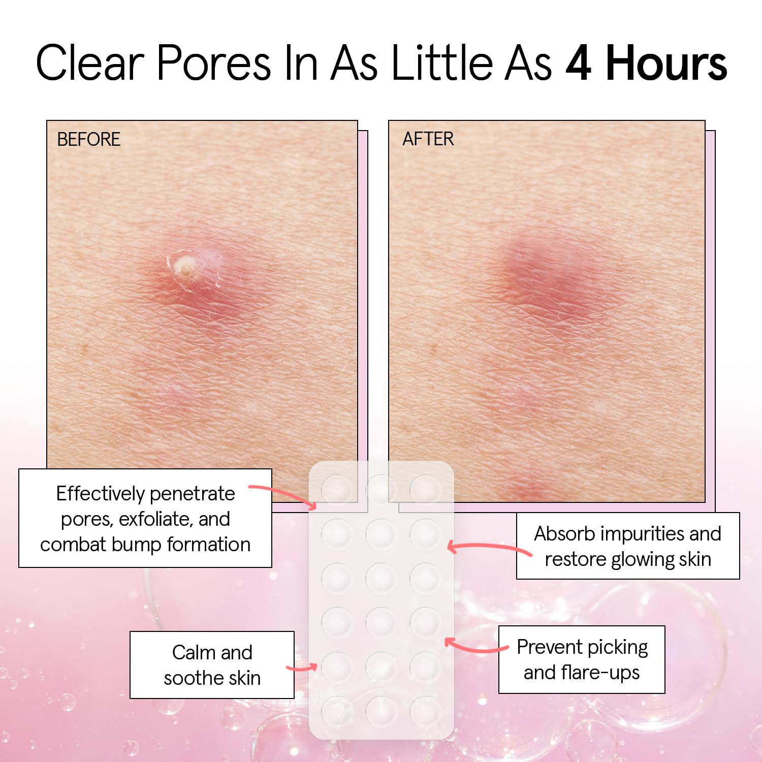 grace & stella Award Winning Invisible Spot Covers with Hydrocolloid (Round, 72 Count) - Spot Covers with Salicylic Acid and Tea Tree for Absorbing Impurities - Dermatologist Tested Skin Care, Cruelty Free, Vegan 🍁 All In One Marketplace Canada