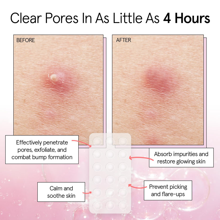 grace & stella Award Winning Invisible Spot Covers with Hydrocolloid (Round, 72 Count) - Spot Covers with Salicylic Acid and Tea Tree for Absorbing Impurities - Dermatologist Tested Skin Care, Cruelty Free, Vegan 🍁 All In One Marketplace Canada