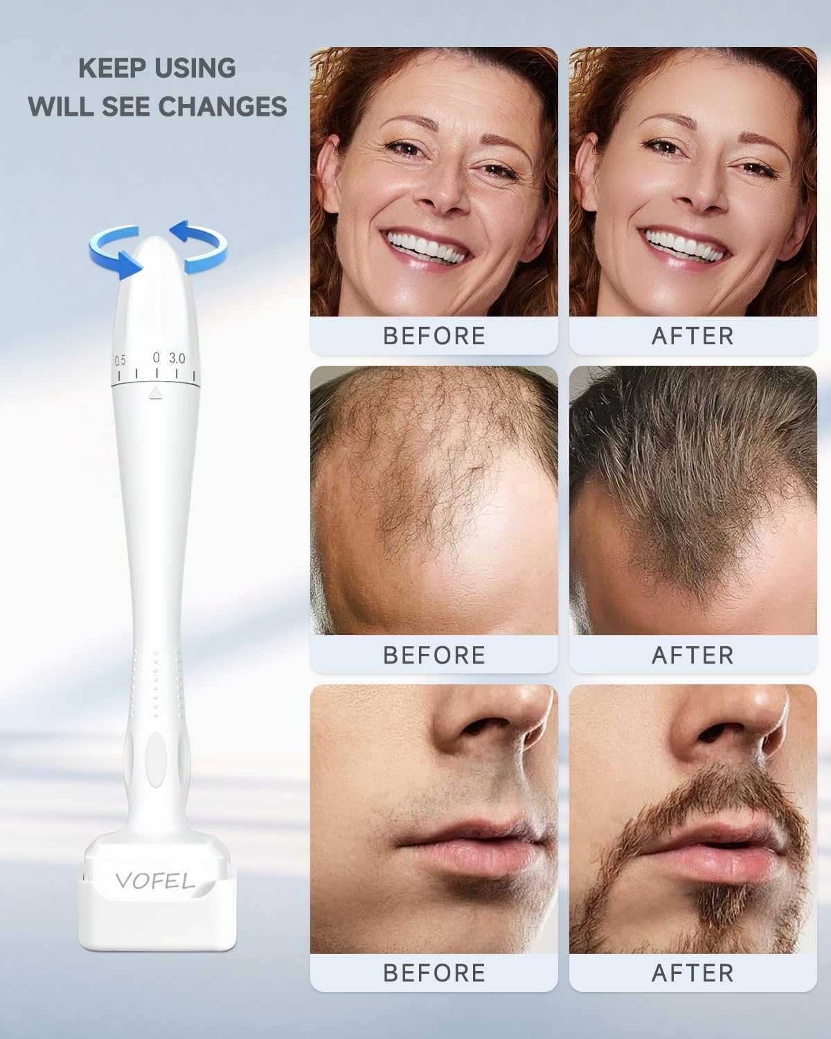 VOFEL Derma Stamp for Hair Growth 140 Microneedling Stamp Adjustable Derma Roller for Face 0-3mm Dermal Roller - SR Home Use (1PC) 🍁 All In One Marketplace Canada