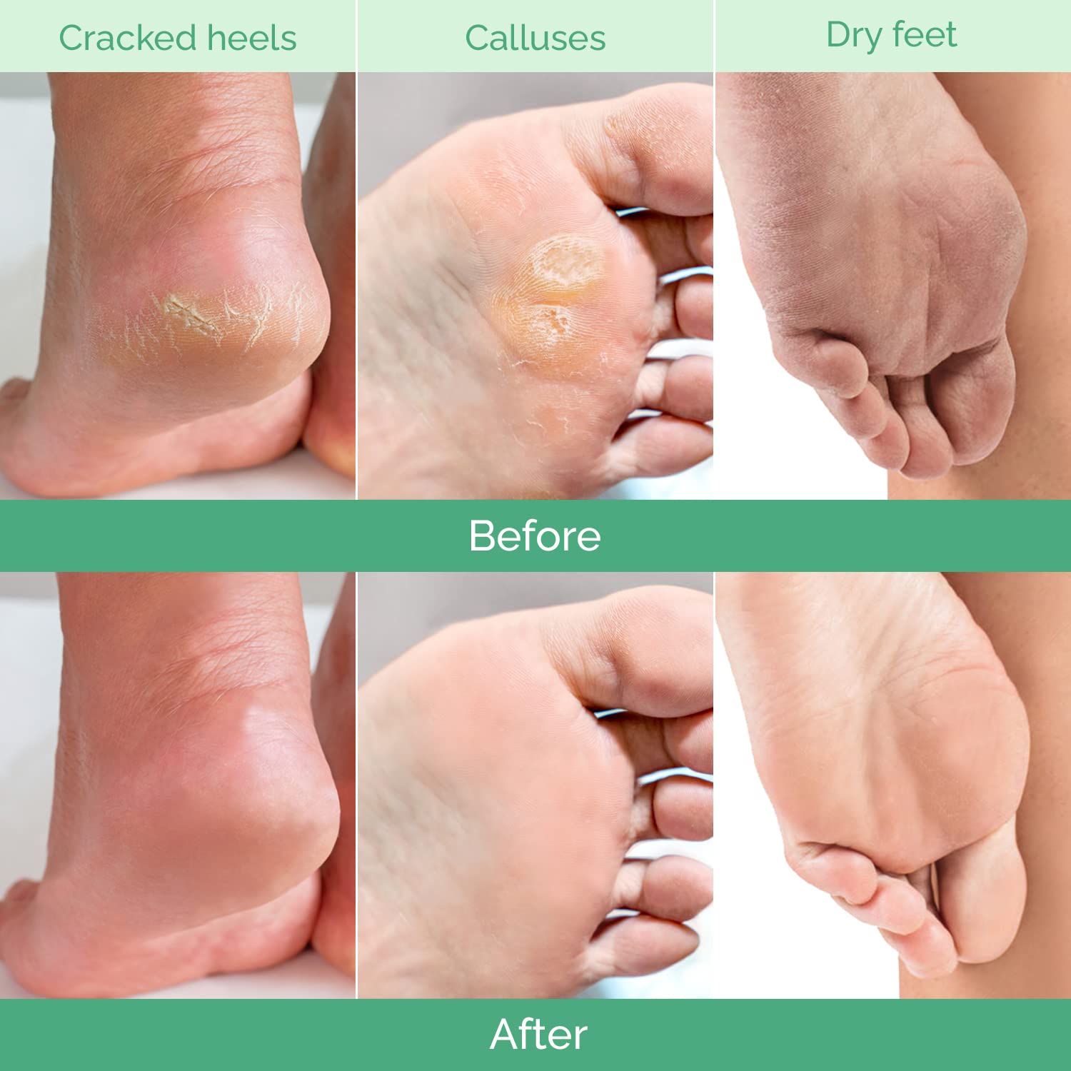 PLANTIFIQUE Foot Peel Mask Dermatologically Tested - 2 Pairs Peach Exfoliating Mask for Dry Cracked Feet - Masque Pied Peeling - Foot Care for Soft Baby Feet 🍁 All In One Marketplace Canada