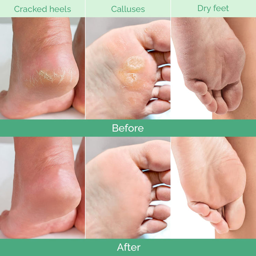 PLANTIFIQUE Foot Peel Mask Dermatologically Tested - 2 Pairs Peach Exfoliating Mask for Dry Cracked Feet - Masque Pied Peeling - Foot Care for Soft Baby Feet 🍁 All In One Marketplace Canada