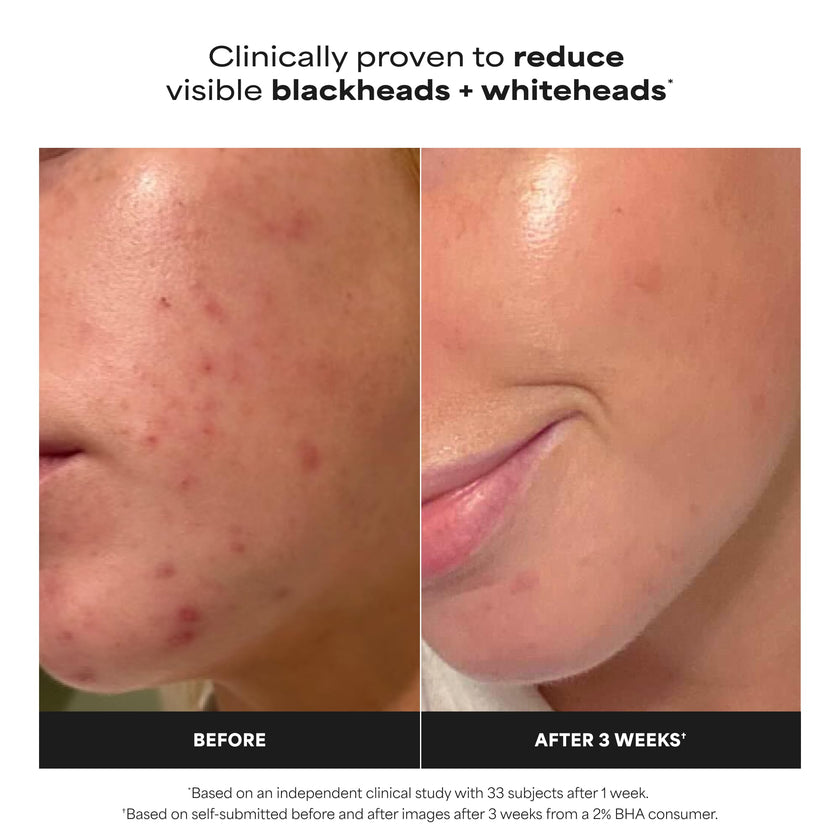 Paula's Choice SKIN PERFECTING 2% BHA Liquid Salicylic Acid Exfoliant, Daily Facial Exfoliator for Enlarged Pores, Wrinkles & Fine Lines, Fragrance-Free, Full Size - 118 ml 🍁 All In One Marketplace Canada
