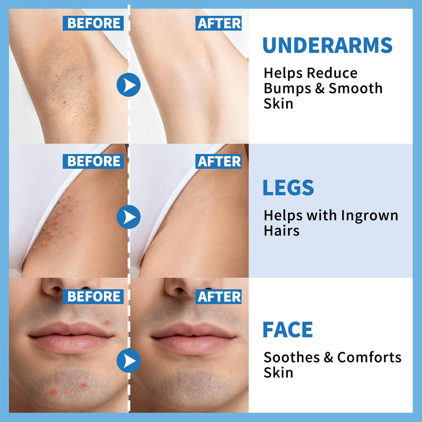 dewyhour Ingrown Hair & After Shave Soothing Serum – Soothes Razor Irritation, Targets Dark Spots, Helps With Razor Bumps for Face, Underarms, Neck & Bikini Area. Korean Skincare Roll-On for Men & Women 🍁 All In One Marketplace Canada