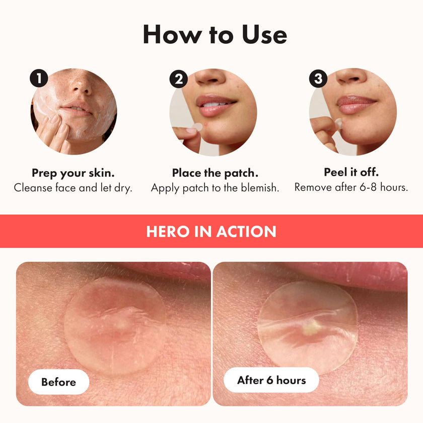 Hero Cosmetics Mighty Patch Original – Hydrocolloid Patch for Pimples, Overnight Acne Blemish & Zit Stickers for Sensitive Skin, (72 Count) 🍁 All In One Marketplace Canada