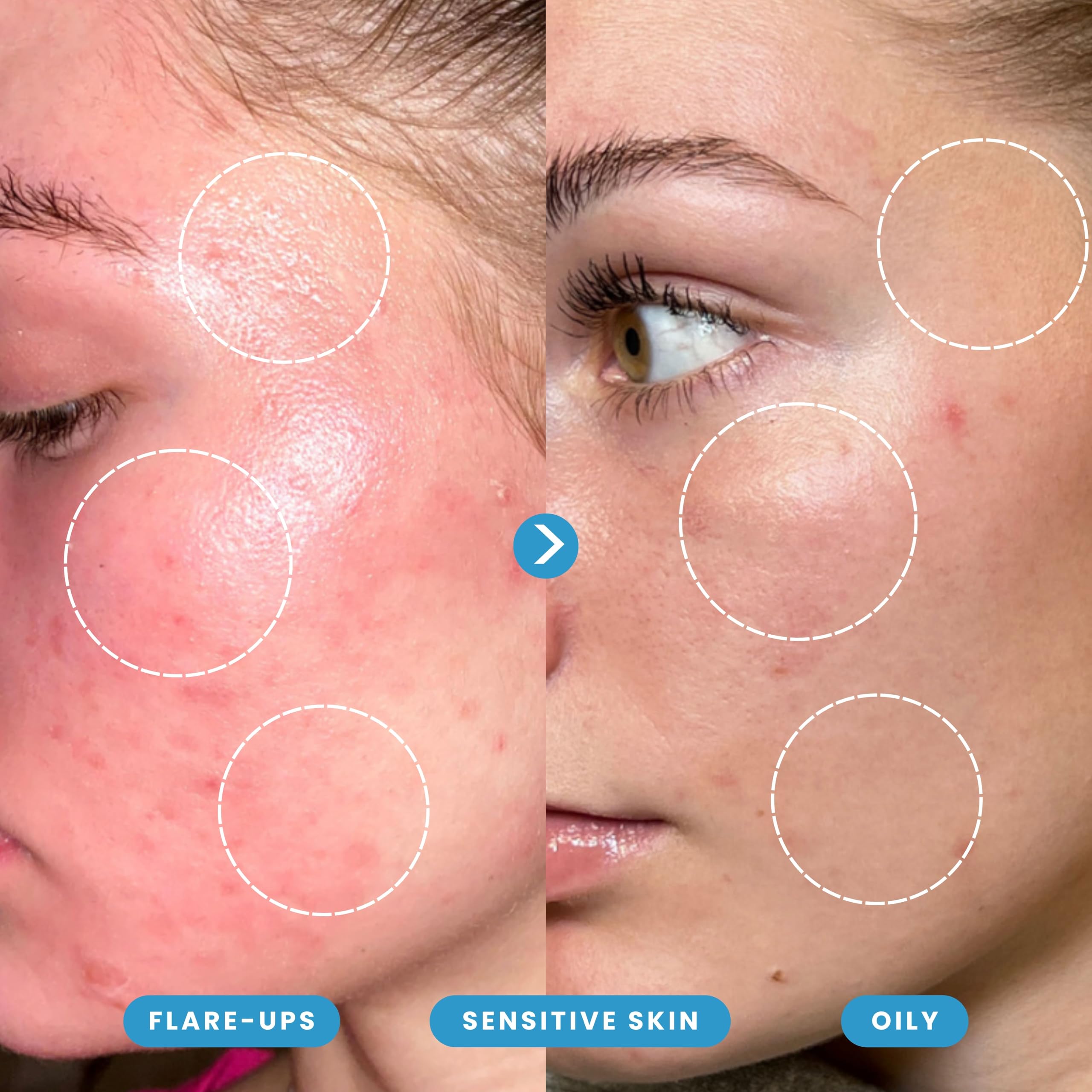 Hypochlorous Acid Spray – Dermatologist Tested HOCl Facial Cleanser for Sensitive, Acne-Prone & Irritated Skin – Soothes Redness, Eczema, Rashes & Itching – Skin Repair Spray, 200 mL - Honeydew Labs 🍁 All In One Marketplace Canada
