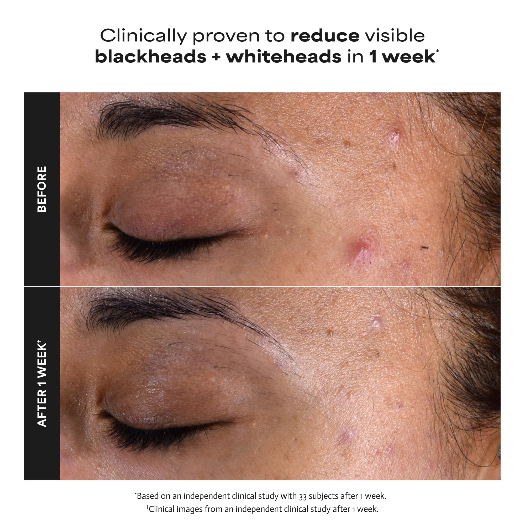 Paula's Choice SKIN PERFECTING 2% BHA Liquid Salicylic Acid Exfoliant, Daily Facial Exfoliator for Enlarged Pores, Wrinkles & Fine Lines, Fragrance-Free, Full Size - 118 ml 🍁 All In One Marketplace Canada