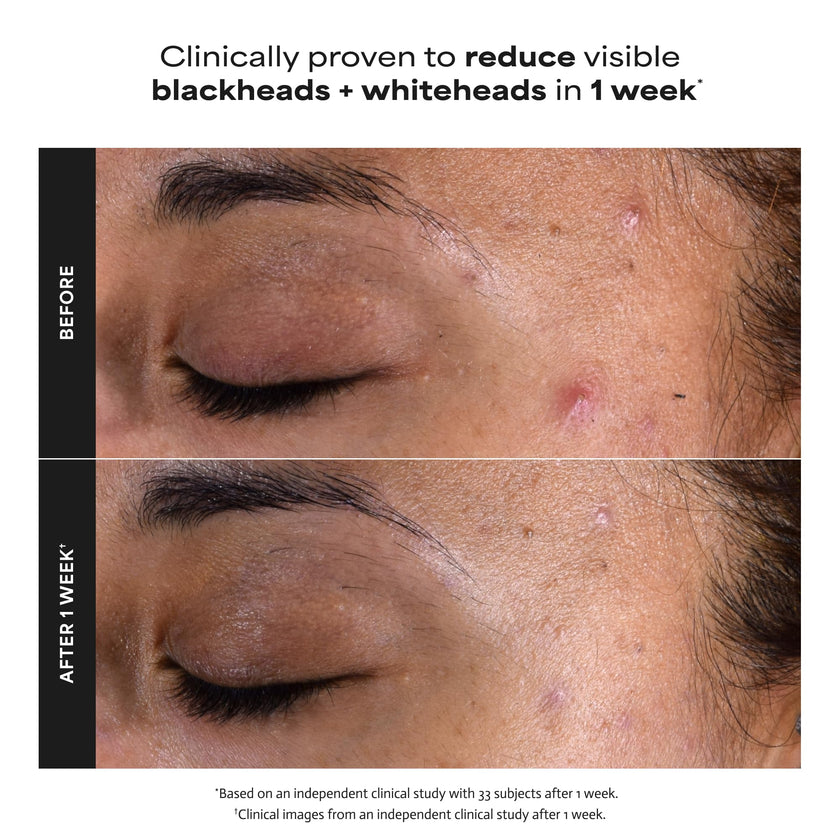 Paula's Choice SKIN PERFECTING 2% BHA Liquid Salicylic Acid Exfoliant, Daily Facial Exfoliator for Enlarged Pores, Wrinkles & Fine Lines, Fragrance-Free, Full Size - 118 ml 🍁 All In One Marketplace Canada