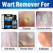OSNOIA Extra Strength Wart Remover Liquid with 17% Salicylic Acid, Fast Acting Treatment for Plantar & Common Warts, Corn Remover for Feet and Toes (15ml, Wart Remover Set) 🍁 All In One Marketplace Canada