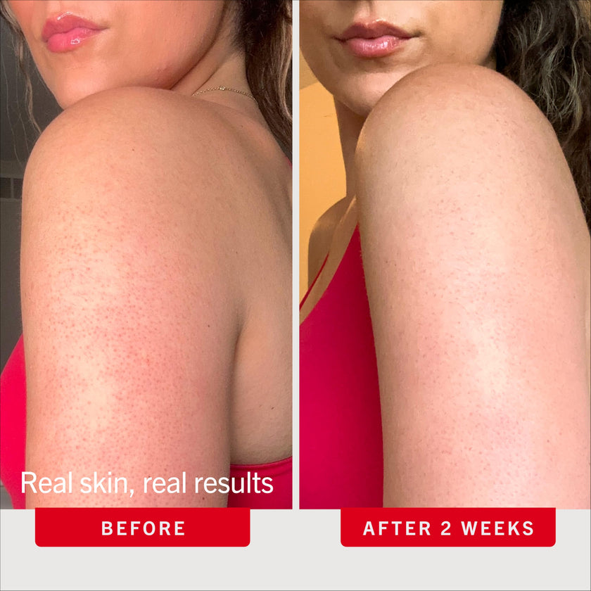 First Aid Beauty KP Bump Eraser Body Scrub, 10% AHA Keratosis Pilaris Exfoliator - Glycolic & Lactic Acid with Pumice, Treatment for Strawberry Legs, Razor Bumps & Rough Bumpy Skin, Safe for Sensitive Skin, 10 oz, Unscented 🍁 All In One Marketplace Canada