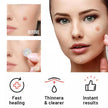 Hydrocolloid Acne Pimple Patches – Invisible Blemish Spot Treatment for Fast Healing