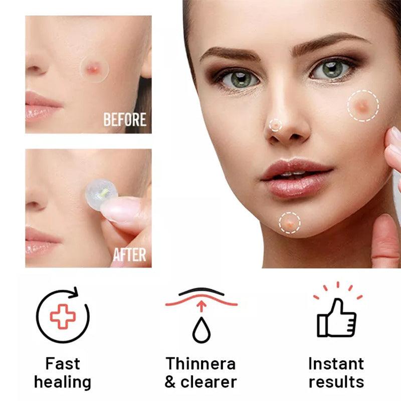 Hydrocolloid Acne Pimple Patches – Invisible Blemish Spot Treatment for Fast Healing
