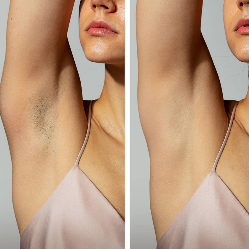 FOREO PEACH 2 Advanced IPL Hair Removal Device