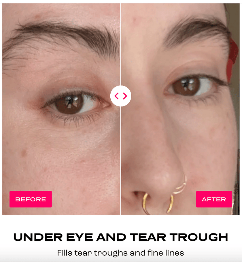 Plump It! No Needles Dermal Filler (30 applications)