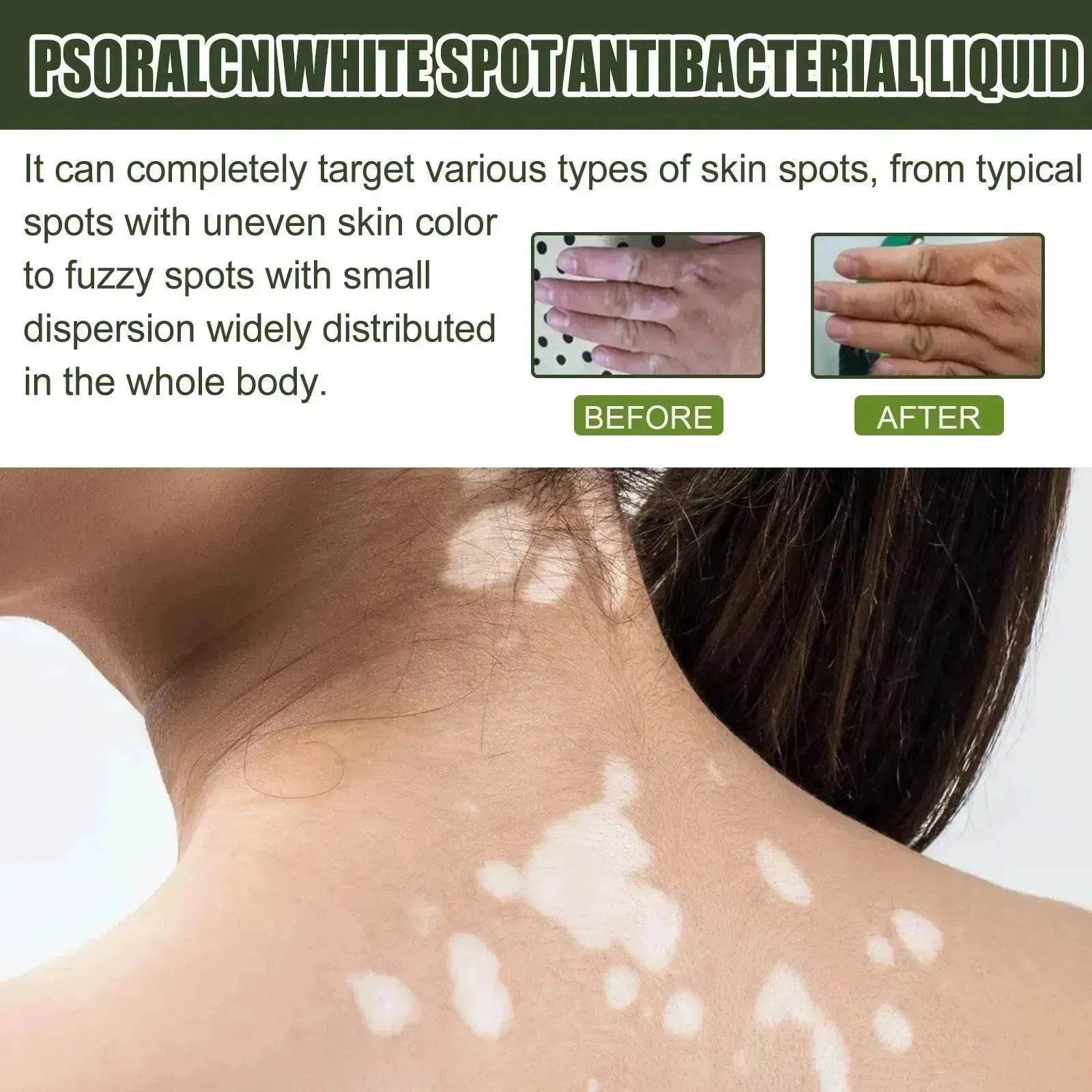 EELHOE White Spot Cleansing Serum  PSORALCN White Spot Antibacterial Liquid.
