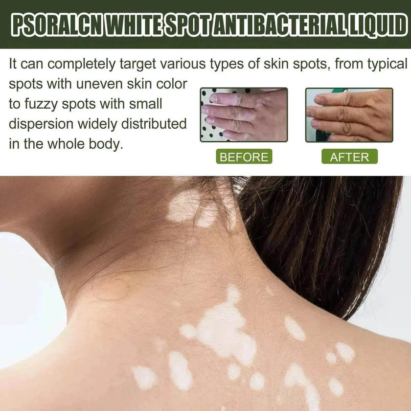 EELHOE White Spot Cleansing Serum  PSORALCN White Spot Antibacterial Liquid.