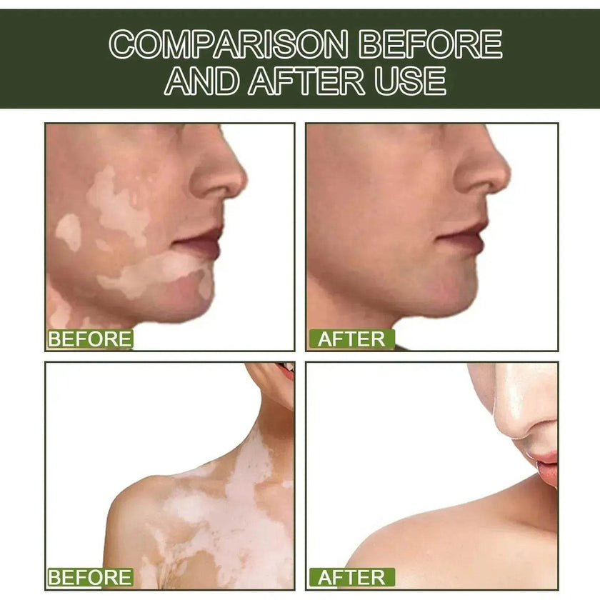 EELHOE White Spot Cleansing Serum  PSORALCN White Spot Antibacterial Liquid.