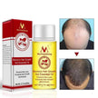 Hair Growth Oil – Anti Hair Loss Scalp Treatment Oil for Thicker, Stronger & Shinier Hair
