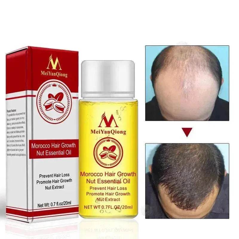 Hair Growth Oil – Anti Hair Loss Scalp Treatment Oil for Thicker, Stronger & Shinier Hair