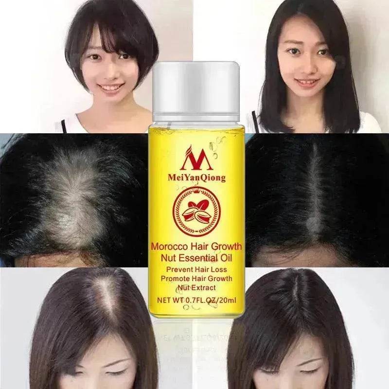 Hair Growth Oil – Anti Hair Loss Scalp Treatment Oil for Thicker, Stronger & Shinier Hair