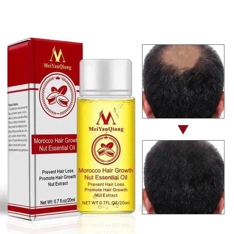 Hair Growth Oil – Anti Hair Loss Scalp Treatment Oil for Thicker, Stronger & Shinier Hair