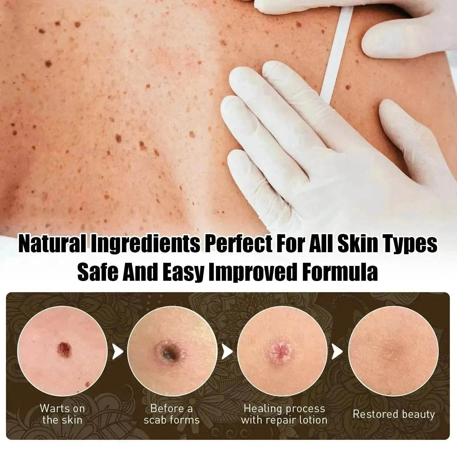 Wart Removal - Skin Cleansing Black Mole Wart Ointment Hand & Foot And Face