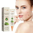 Wart Removal - Skin Cleansing Black Mole Wart Ointment Hand & Foot And Face