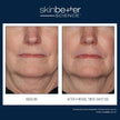 Skinbetter Science - Interfuse Treatment Cream Face & Neck