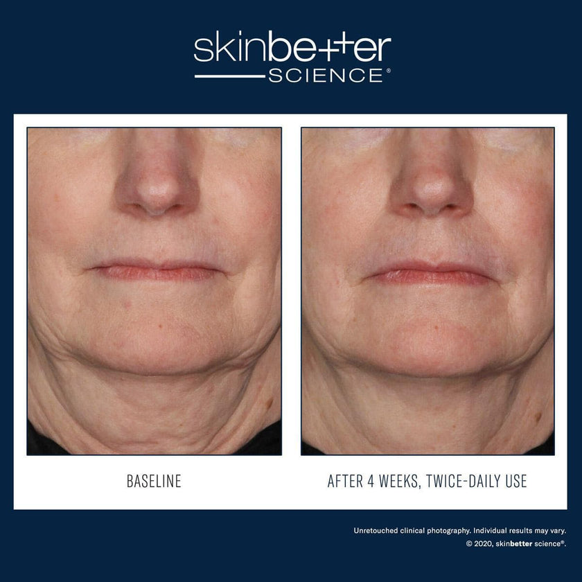 Skinbetter Science - Interfuse Treatment Cream Face & Neck